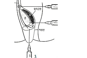 치질수술